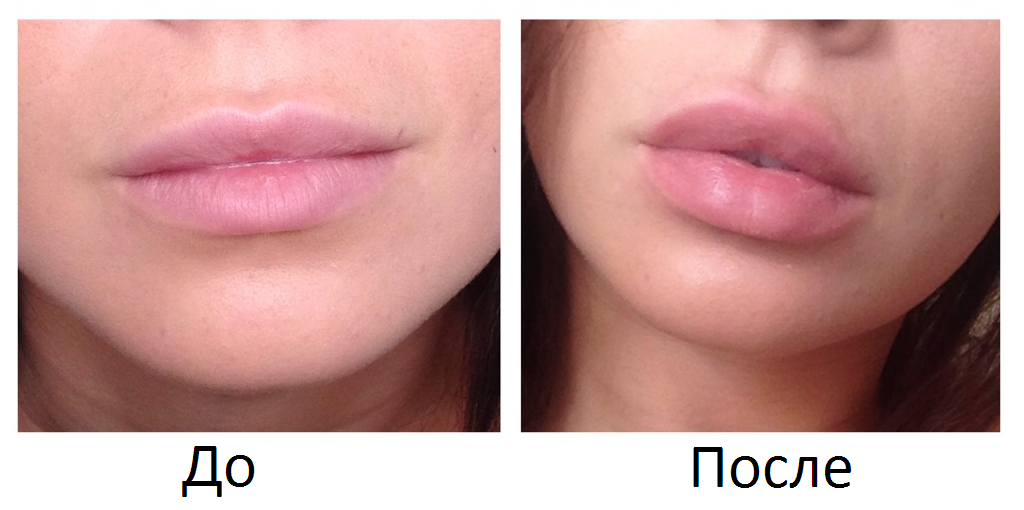 Увеличение губ: как подчеркнуть естественную красоту